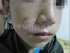 【NO.59990病例】10岁孩子选择南京华厦治好了唇部白斑